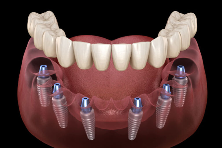 full mouth dental implants garner