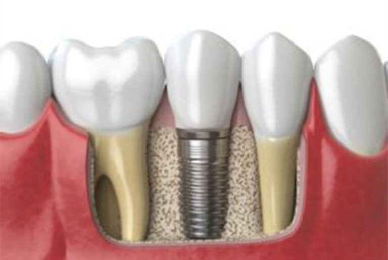 Dental Implants In Zebulon