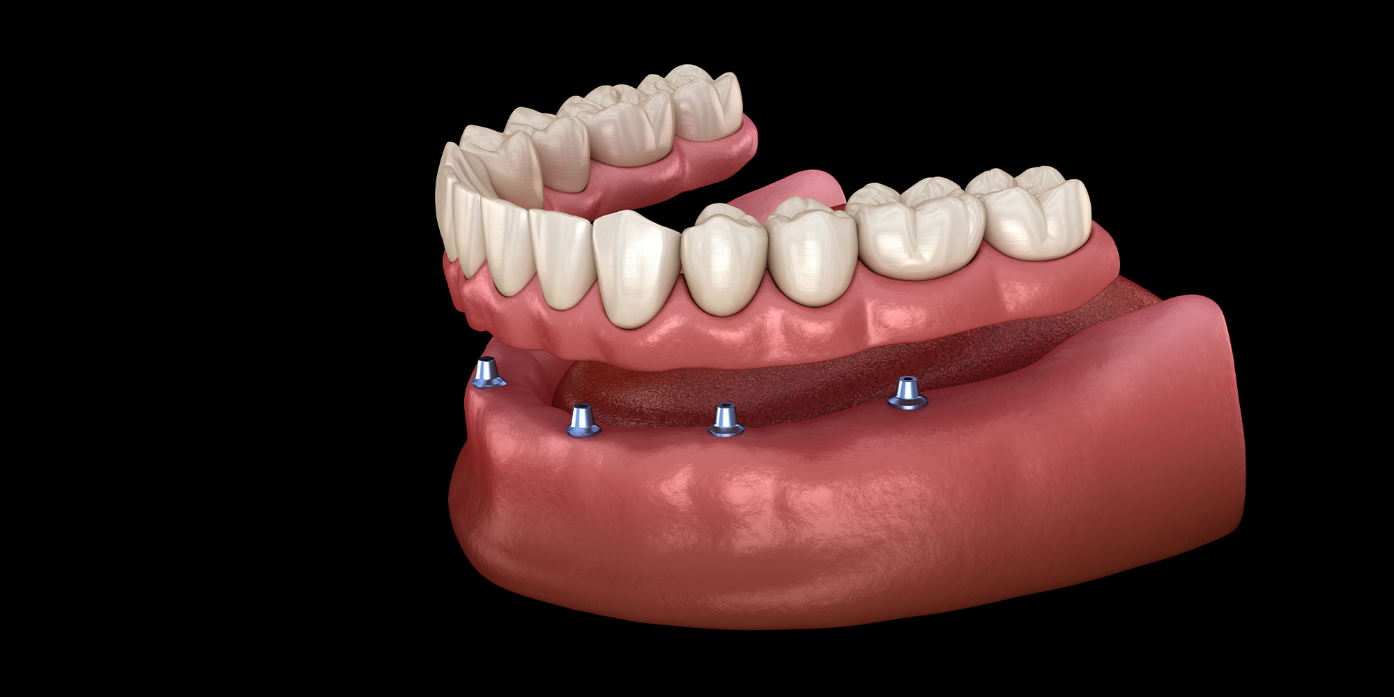 implant supported dentures Dental Implants in Morrisville