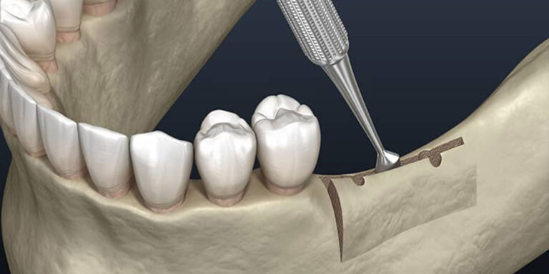 Trust Highland Implant Center for the best dental implants in Rolesville